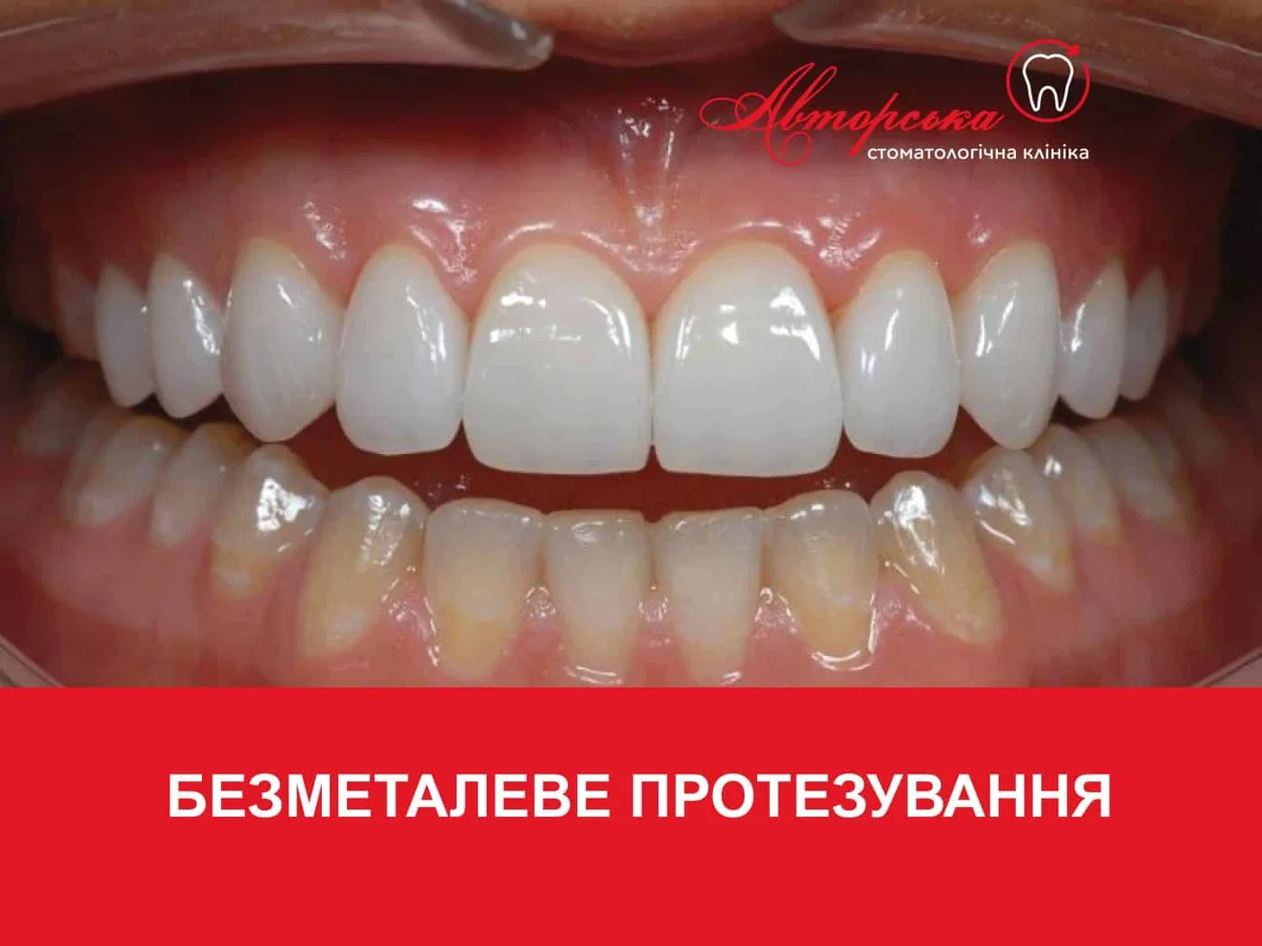 Ряди білих зубів, напис «Безметалеве протезування»